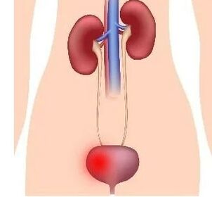 D'Grënn fir d'Entwécklung vu Cystitis a Frae