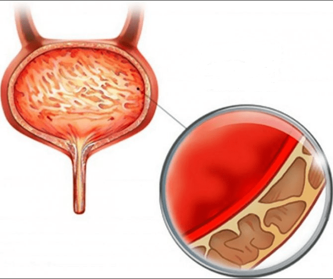 Entzündung vu Cystitis