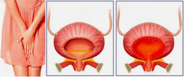 Chronesch Zystitis