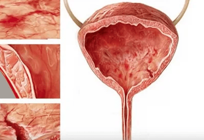 D'Grënn fir d'Entwécklung vu Cystitis a Frae