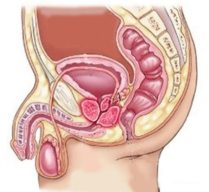 Ursaachen vun Cystitis bei Männer